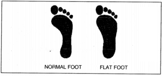 Why flat foot are formed? Give the recomended exercises for flat foot ...